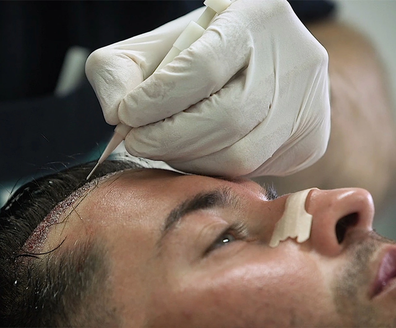 Μεταμοσχεύσεις Μαλλιών Direct FUE by Seneca Καλαμάτα