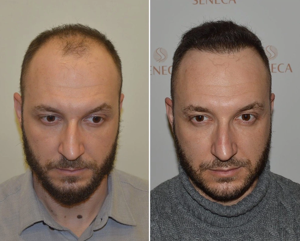 Ηair Clinic Καλαμάτα