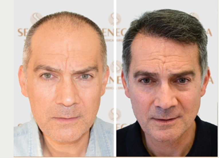 Ηair Clinic Καλαμάτα